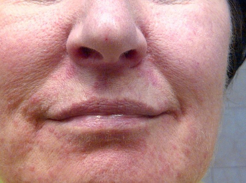 Picture of Perioral Dermatitis - WebMD